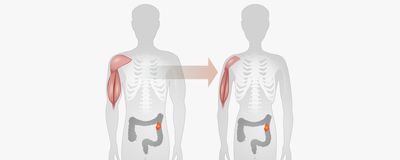 An illustration showing reduction in muscle mass and weight from cachexia.
