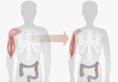 An illustration showing reduction in muscle mass and weight from cachexia.