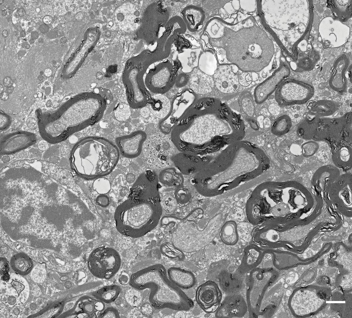 Electron microscopy shows myelin overgrowth around axons in the white matter of a patient with ALSP. Electron microscopy shows myelin overgrowth around axons in the white matter of a patient with ALSP.