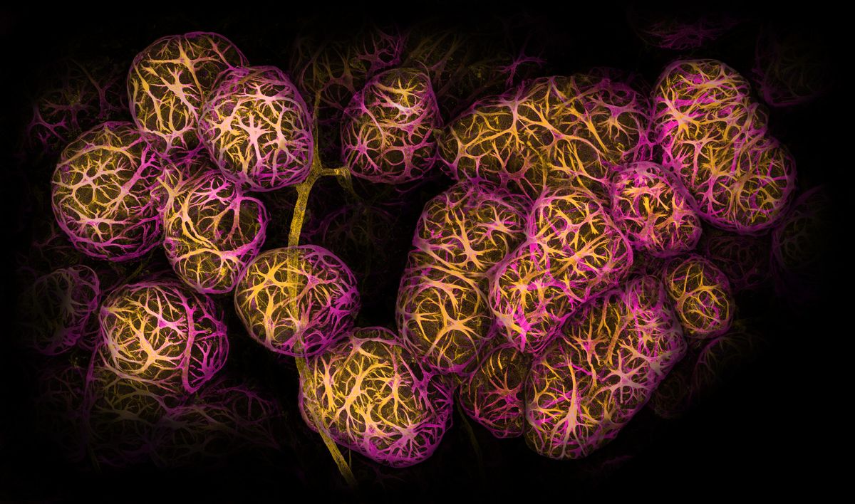 Breast tissue shown in pink and yellow Breast tissue shown in pink and yellow