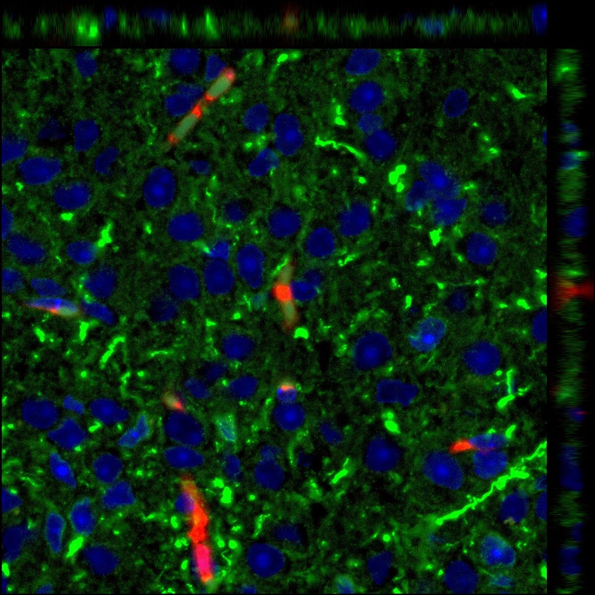 Neurons (green) taking up breast cancer extracellular vesicles (red).